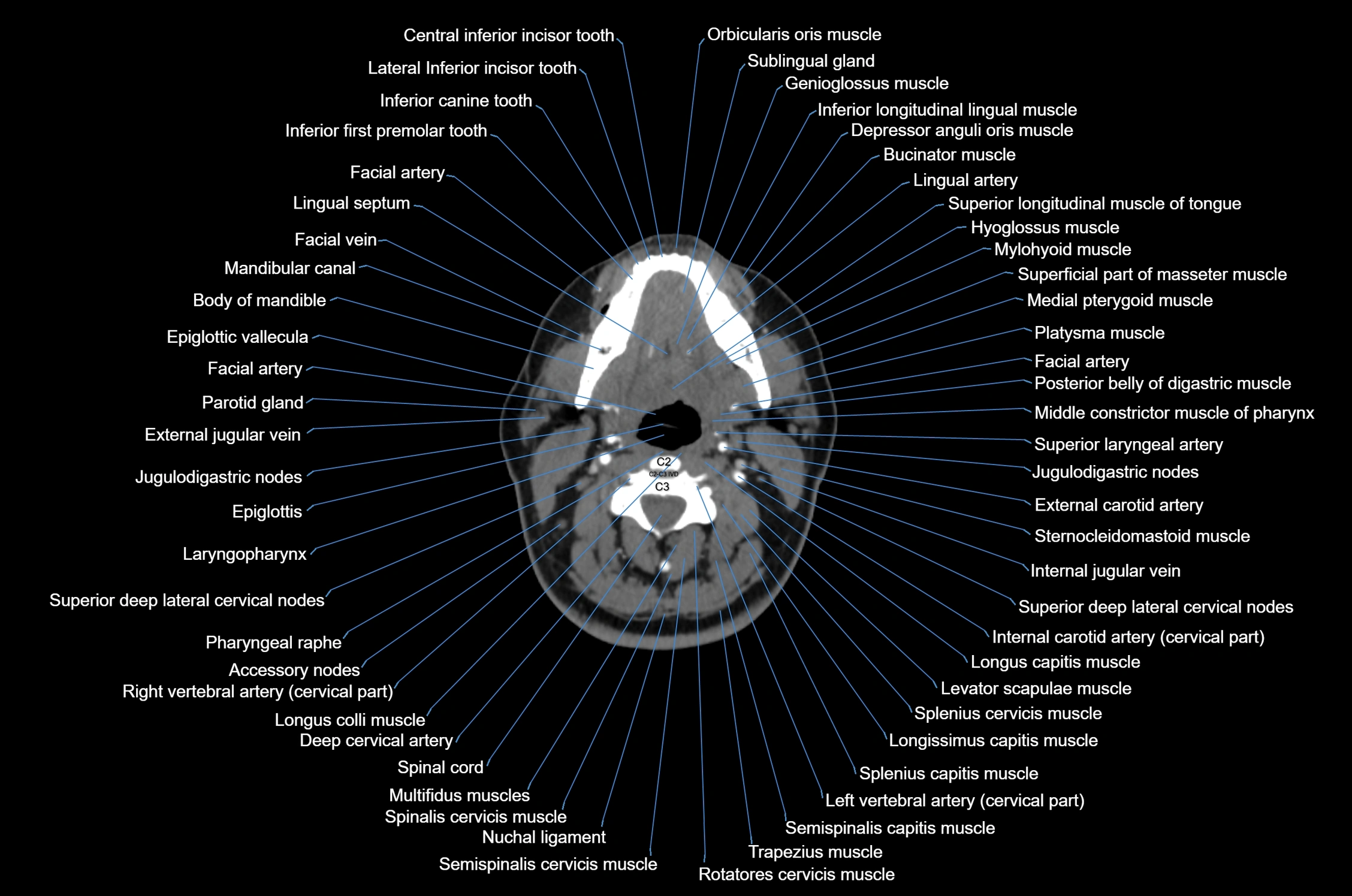 CT Neck axial cross sectional anatomy radiology image-img-00001-00032.webp